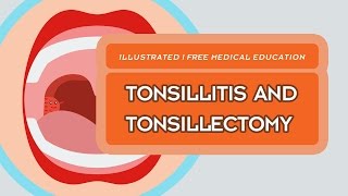 What is Tonsillitis amp Tonsillectomy [upl. by Fawcett]