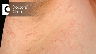 Treatment for lichen planus amp its correlation with mosquito bite  Dr Aruna Prasad [upl. by Leksehc]