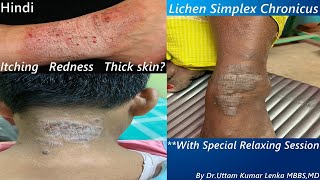 Lichen Simplex Chronicus  Treatment of thickened itchy skindry eczema treatment Dr Uttam Lenka [upl. by Ahselrac]