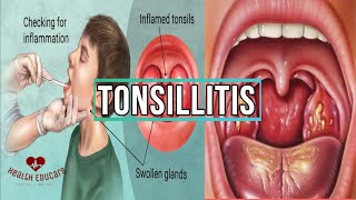 9 Signs and Symptoms of Tonsillitis [upl. by Lorie234]