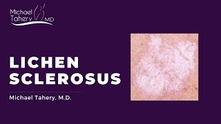 Lichen Sclerosus Treatment [upl. by Cory586]