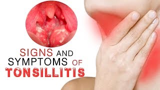 Bacterial tonsillitis  Viral tonsillitis  Untreated tonsillitis complications [upl. by Obaza]