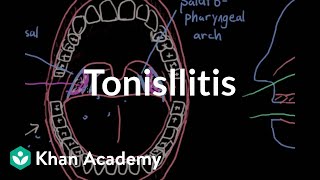 Tonsil stones becoming more common [upl. by Readus]