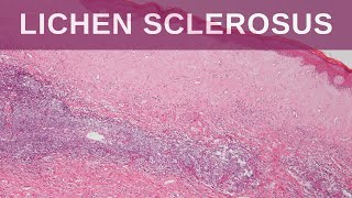 Lichen Sclerosus  Pathology mini tutorial [upl. by Zea]