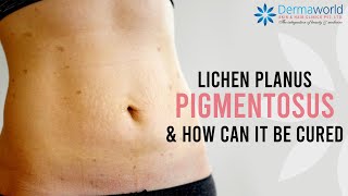 How to cure Lichen Planus Pigmentosus  Lichen Planus Pigmentosus Treatment  Dr Rohit Batra [upl. by Yrruc639]