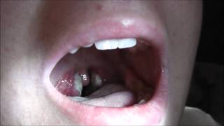 What is Tonsils amp Do You Need Them – DrBerg [upl. by Oibesue]