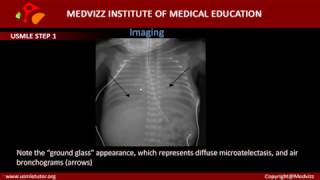 Respiratory Distress Syndrome in Neonates Hyaline Membrane Disease [upl. by Selassie953]