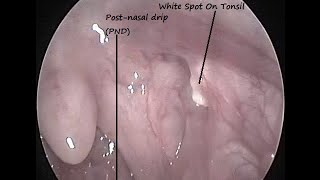 Warning signs of tonsillitis  Dr Sriram Nathan [upl. by Katlin645]