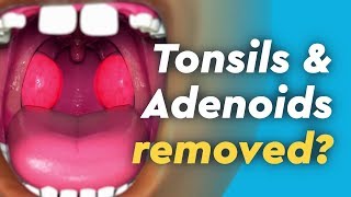 Treatment for Chronic Tonsillitis  Dr Sreenivasa Murthy T M [upl. by Enidlarej]