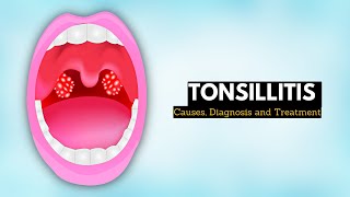 EvidenceBased Interventions tonsillectomy for recurrent tonsillitis surgery [upl. by Latvina]